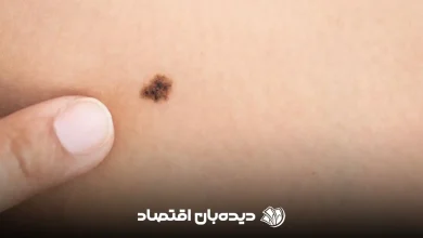 سرطان پوست