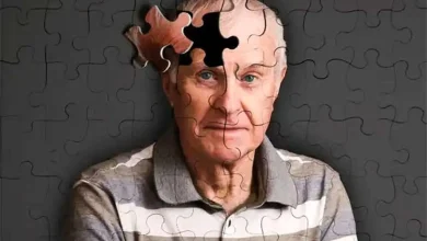 آلزایمر