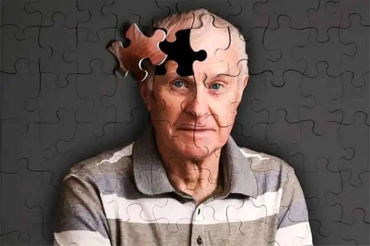 آلزایمر